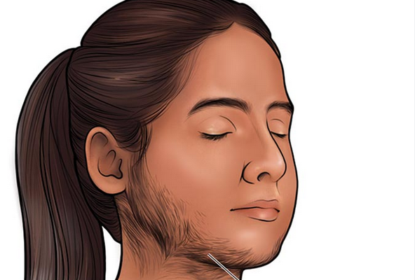 महिलांच्या चेहऱ्यावरील अनावश्यक केस  (Unwanted facial hair in women)