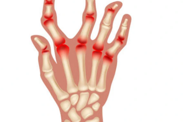 संधिवात (Rheumatism)