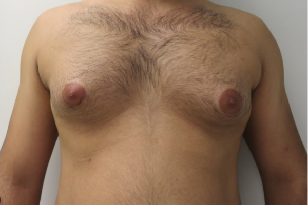 पुरूषांमधील स्तनांची वाढ (Gynaecomastia)