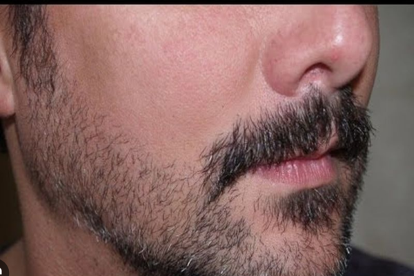 पुरूषांमध्ये दाढी/मिशी न येणे (No / poor beard and moustache)